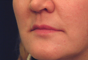Restylane before 149882