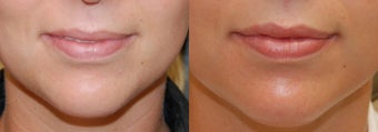 Lip Augmentation with Silikon-1000 before 119383