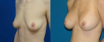 24 year old, 300cc left 325cc right, modified lift on left after 1079073