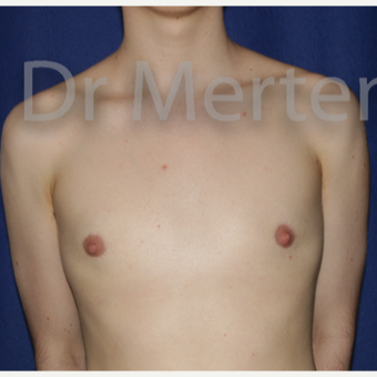 18-24 year old man treated with FTM Chest Masculinization Surgery after 3829087