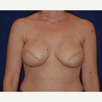 45-year old woman with Nipple Reconstruction before 2434978