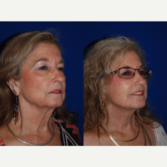 65-74 year old woman treated with Facelift and Necklift after 3659670