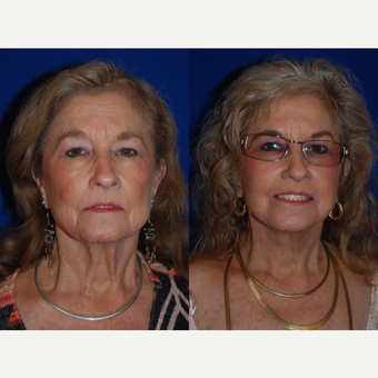 65-74 year old woman treated with Facelift and Necklift before 3659670