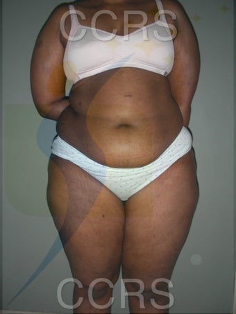 28 yr. old with generalised fat deposition (VASER) before 1034231