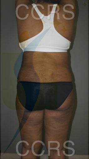 28 yr. old with generalised fat deposition (VASER) 1034231