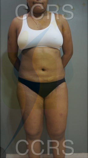 28 yr. old with generalised fat deposition (VASER) after 1034231
