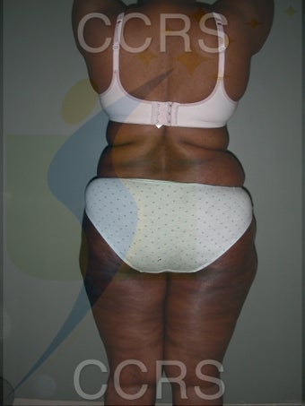 28 yr. old with generalised fat deposition (VASER) 1034231