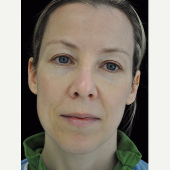 25-34 year old woman treated with IPL photofacial series after 3265921