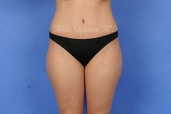 27 Year Old Female Tummy Tuck and Lipo after 975121