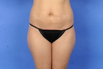 27 Year Old Female Tummy Tuck and Lipo before 975121