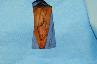 Labiaplasty before 1518913