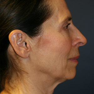 62 year old woman treated with Neck Lift, Lower Face Lift, and Laser Skin Smoothing before 2870034