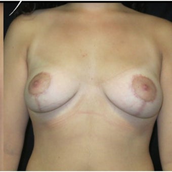 18-24 year old woman treated with Breast Lift after 2121634