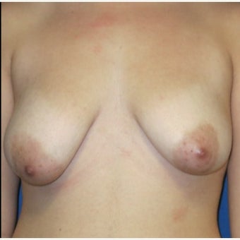 18-24 year old woman treated with Breast Lift before 2121634