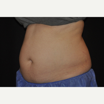 35-44 year old woman treated with CoolSculpting before 3476721