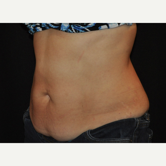 35-44 year old woman treated with CoolSculpting after 3476721
