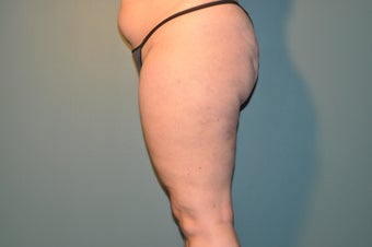 Cellulaze after 1098247