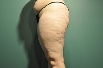 Cellulaze before 1098247