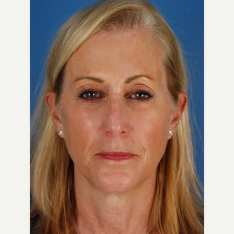 55 year old woman treated with Facial Reconstructive Surgery after 3827591