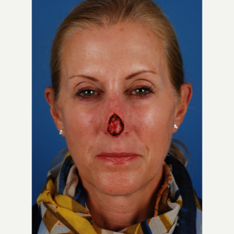 55 year old woman treated with Facial Reconstructive Surgery before 3827591