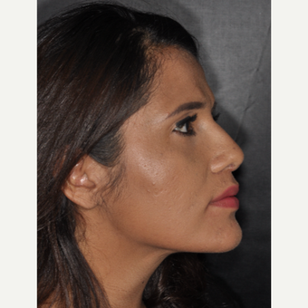 25-34 year old woman treated with Rhinoplasty 10 days post-op after 3452300
