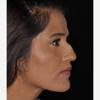 25-34 year old woman treated with Rhinoplasty 10 days post-op before 3452300