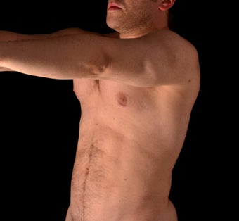 35-44 year old man treated with Liposuction after 1537804