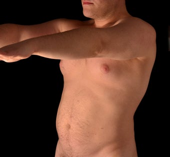 35-44 year old man treated with Liposuction before 1537804