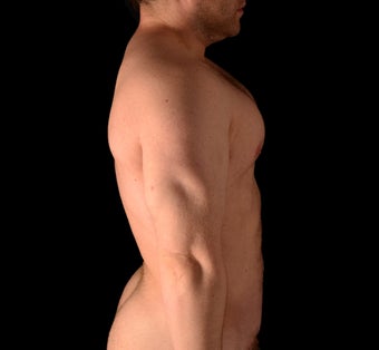 35-44 year old man treated with Liposuction 1537804