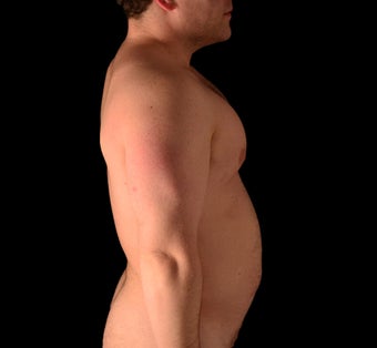 35-44 year old man treated with Liposuction 1537804