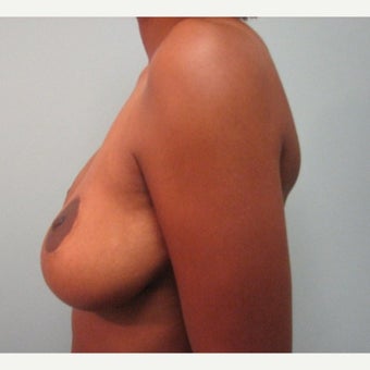 Breast Implant Removal combined with a breast lift in 43 year old patient before 1975742