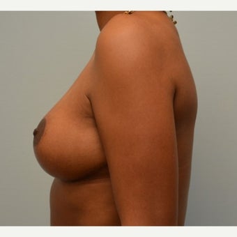 Breast Implant Removal combined with a breast lift in 43 year old patient after 1975742