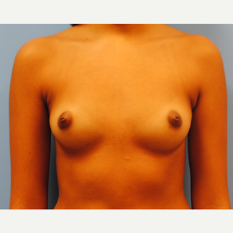 20 year old. Saline breast implants. 290 high profile filled to 300cc. A to C cup before 3312791