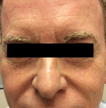 65 year old man treated with Halo Laser before 3210871