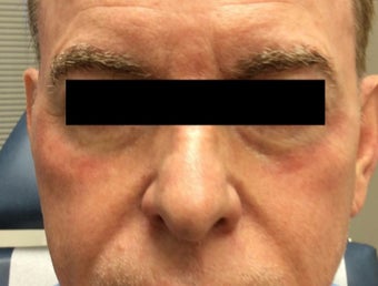 65 year old man treated with Halo Laser after 3210871