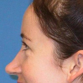 25-34 year old woman treated with Rhinoplasty before 3497234