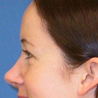 25-34 year old woman treated with Rhinoplasty after 3497234