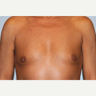 55-64 year old man treated with Male Breast Reduction after 3569487