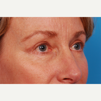 55-64 year old woman treated with Eyelid Surgery after 2995462