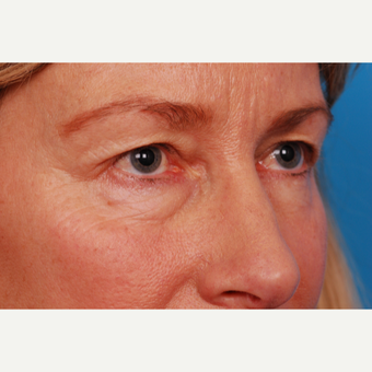 55-64 year old woman treated with Eyelid Surgery before 2995462