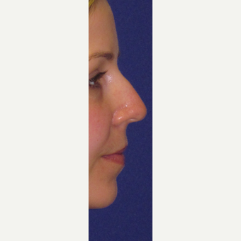 Non Surgical "Liquid" Rhinoplasty before 3202314