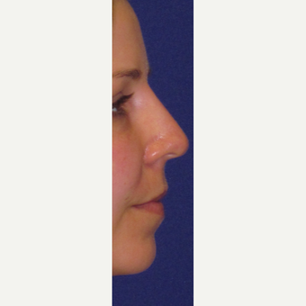 Non Surgical "Liquid" Rhinoplasty after 3202314