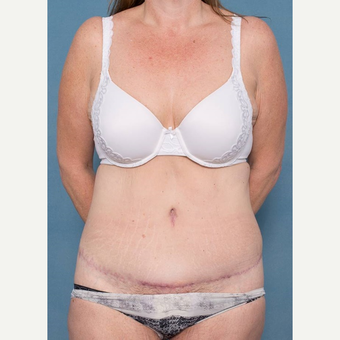 45-54 year old woman treated with Tummy Tuck after 3442425
