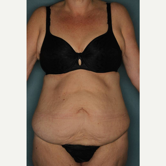 45-54 year old woman treated with Tummy Tuck before 3442425
