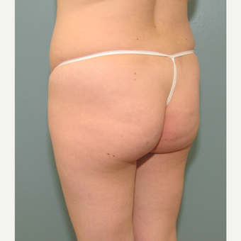 35-44 year old woman liposuction and fat transfer treated with Body Jet before 3141665