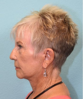75 and up year old woman treated with Facelift after 3581444