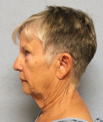 75 and up year old woman treated with Facelift before 3581444