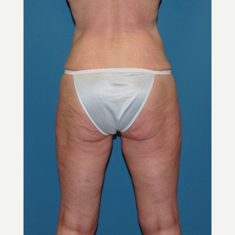 45-54 year old woman treated with Smart Lipo after 3412686