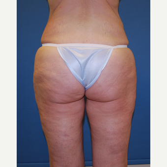 45-54 year old woman treated with Smart Lipo before 3412686