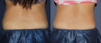 Before & After CoolSculpting before 678455